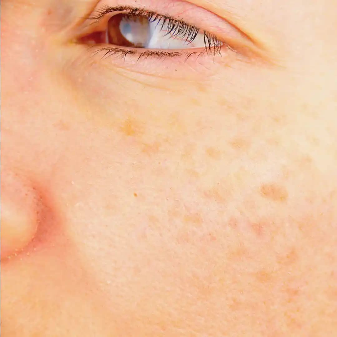 Yüzde Sarı Leke Nedenleri, Giderici Yöntemler ve Güzellik İpuçları