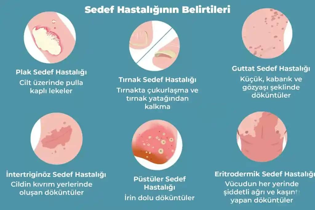 Yüzde Sedef Hastalığı İçin Kozmetik ve Estetik Yaklaşımlar ve Cilt Bakımı Önerileri