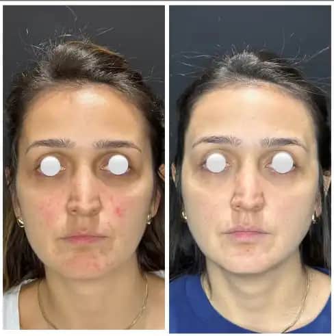 Yüzde Sivilce Benzeri Kabarıklıkların Nedenleri ve Etkili Önleme Yöntemleri