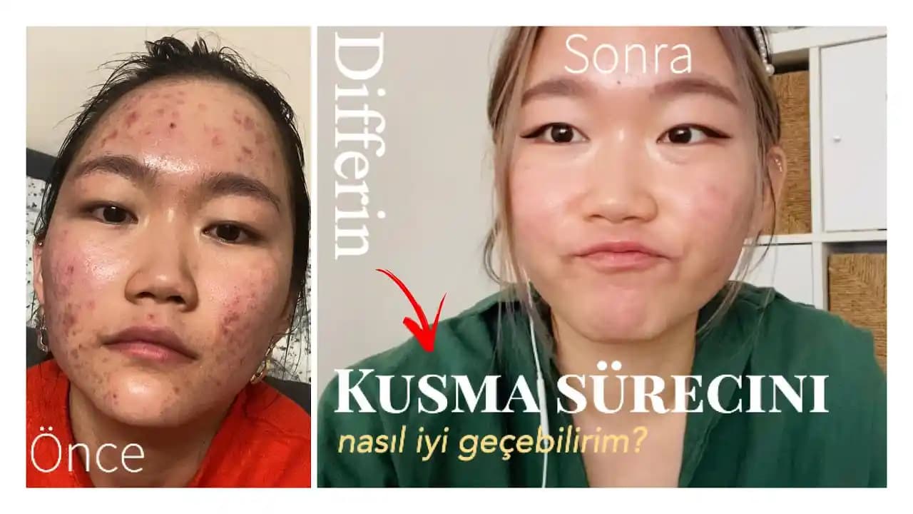 Yüzde Sivilce Kusması: Nedenleri, Bakım Yöntemleri ve Profesyonel Çözümler