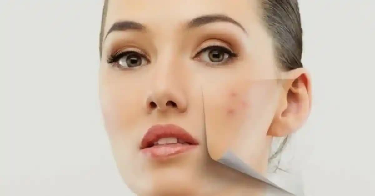 Yüzde Sivilce Nedenleri ve Etkili Cilt Bakımı Yöntemleri Hakkında Detaylı Bilgi