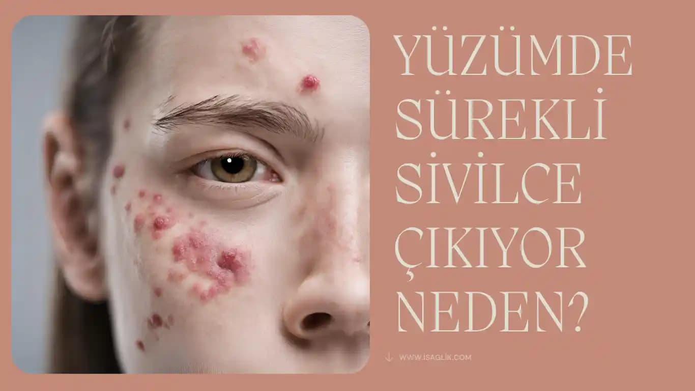 Yüzde Sivilce Sorunu ve Etkili Çözüm Yolları Cilt Sağlığını Koruma Rehberi