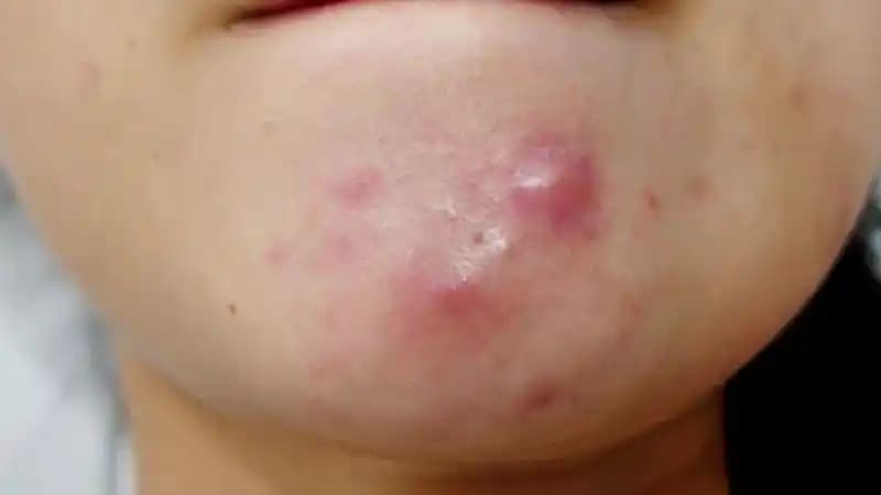 Yüzde Ucu Olmayan Sivilceler İçin Doğru Bakım ve Tedavi Yaklaşımları