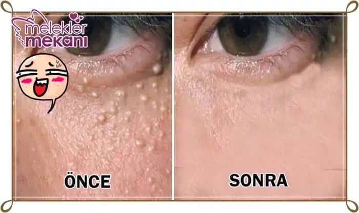 Yüzde Yağ Bezeleri Nedir, Belirtileri ve Etkili Tedavi Yöntemleri