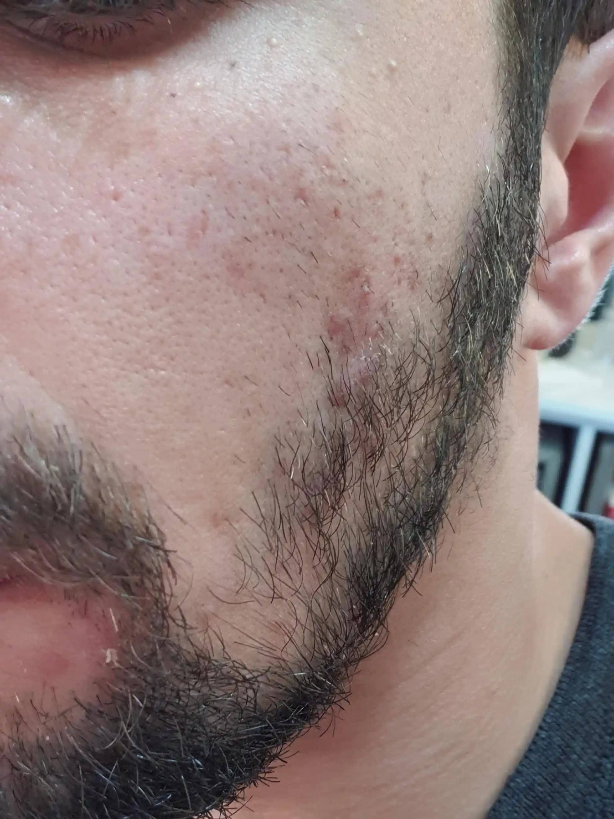 Yüzdeki Akne Nedenleri ve Etkili Tedavi Yöntemleri Hakkında Kapsamlı Bilgi