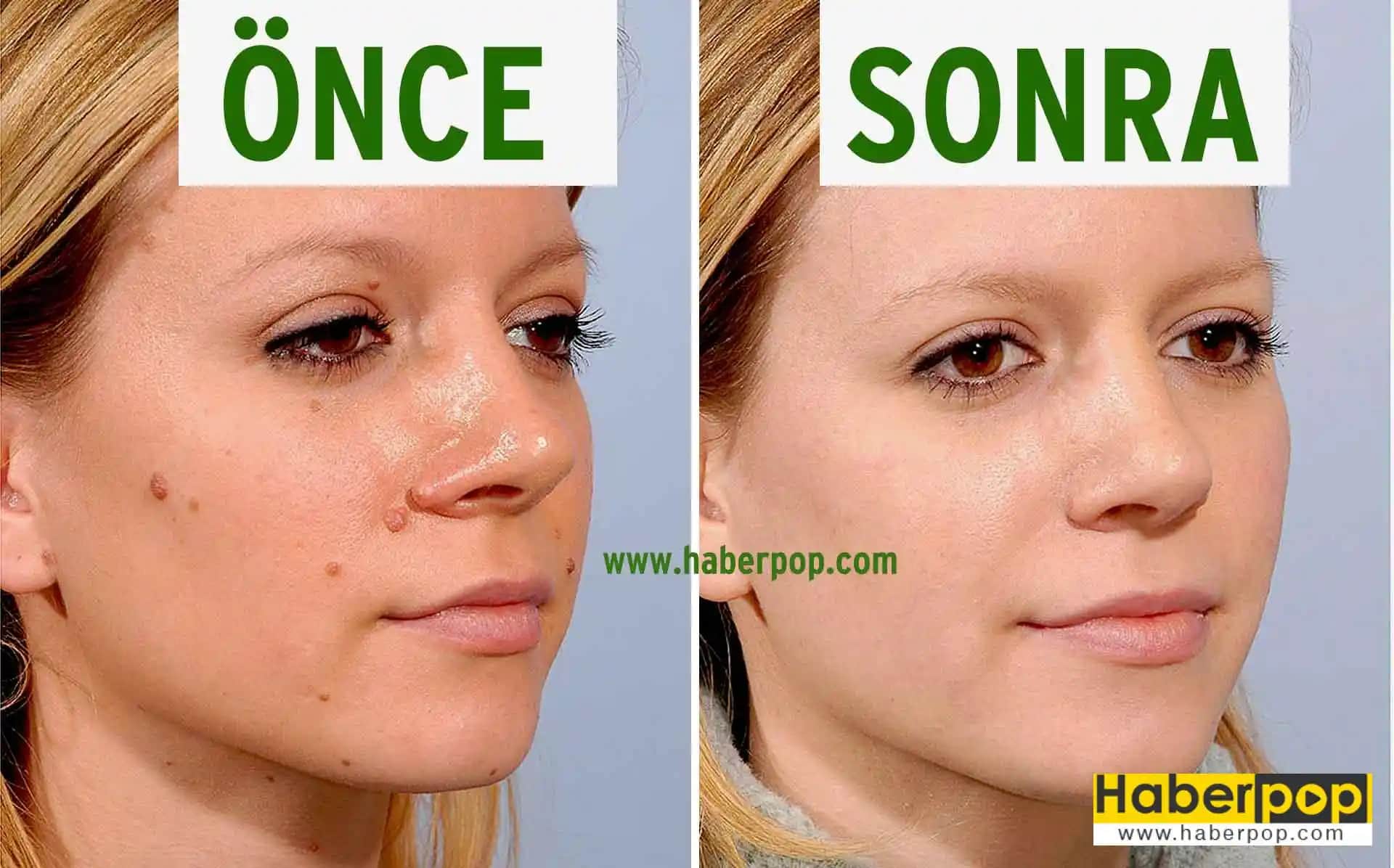 Yüzdeki Benler İçin Güvenilir ve Etkili Krem Kullanımı ve Tedavi Yöntemleri