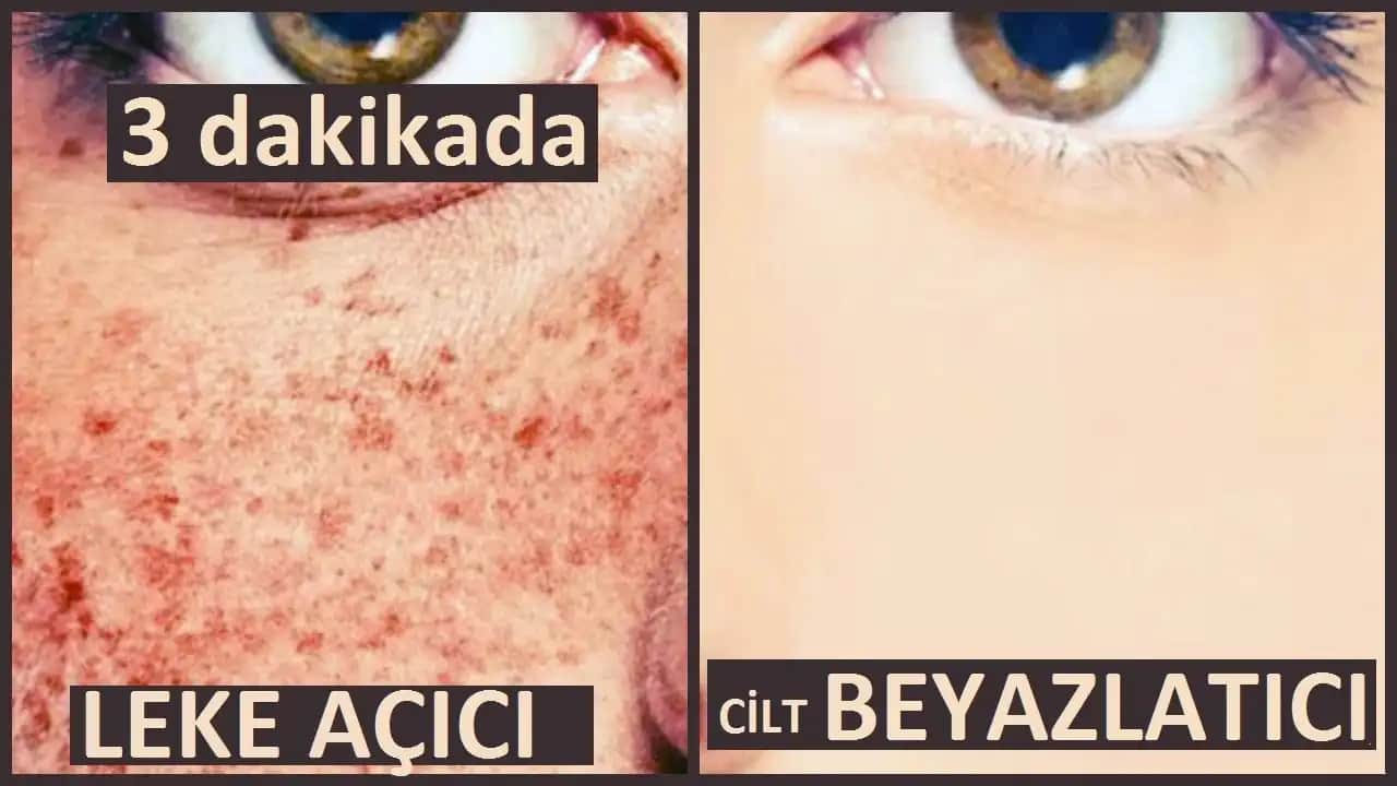 Yüzdeki Beyaz Noktalar İçin En Etkili Kremler ve Bakım Yöntemleri Rehberi