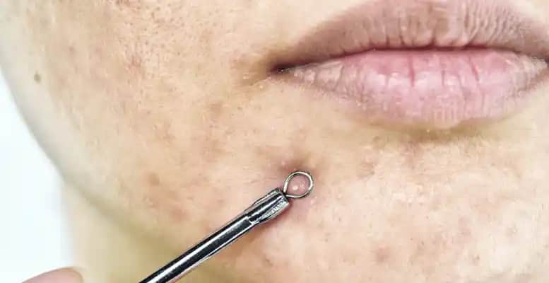 Yüzdeki Beyaz Noktaların Nedenleri ve Etkili Tedavi Yöntemleri