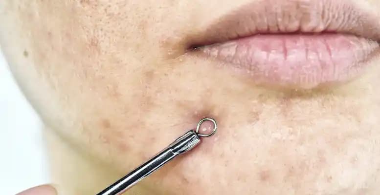 Yüzdeki Beyaz Noktaların Nedenleri ve Etkili Tedavi Yöntemleri