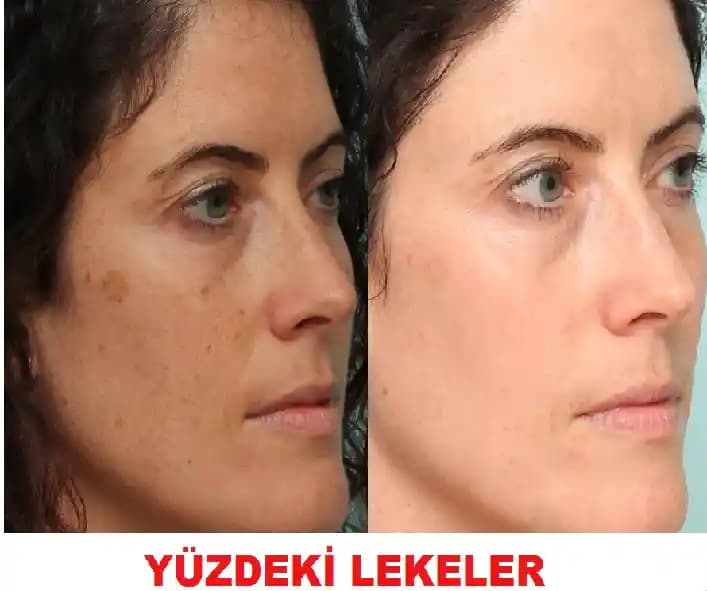 Yüzdeki Cilt Lekeleri Nedenleri ve Etkili Tedavi Yöntemleri Hakkında Bilgiler