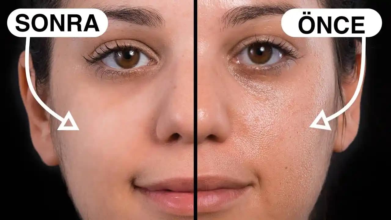 Yüzdeki Çukurların Geçip Geçmeyeceği ve Tedavi Yöntemleri Hakkında Detaylı Bilgi