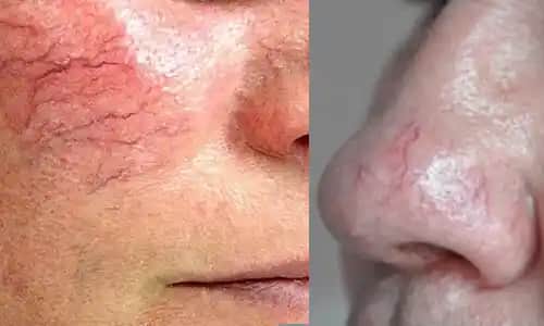 Yüzdeki Damar Görünürlüğü Nedenleri ve Etkili Çözüm Yöntemleri