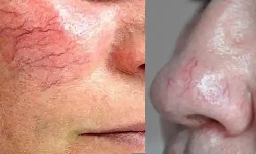 Yüzdeki Damar Görünürlüğü Nedenleri ve Etkili Çözüm Yöntemleri