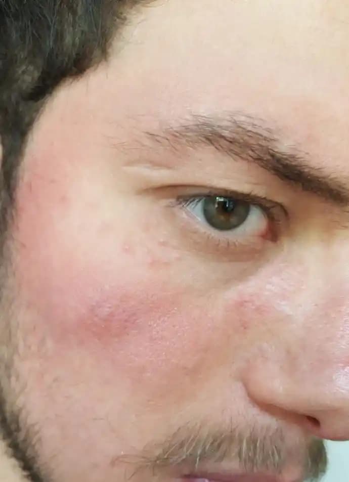 Yüzdeki Deri Dökülmesine Karşı Etkili Çözümler ve Cilt Bakımı Rehberi