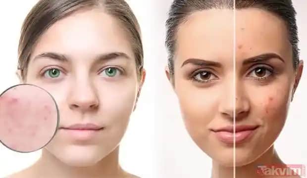 Yüzdeki İltihaplı Sivilceleri Hafifletmek ve Tamamen Geçirmek İçin Etkili Yöntemler