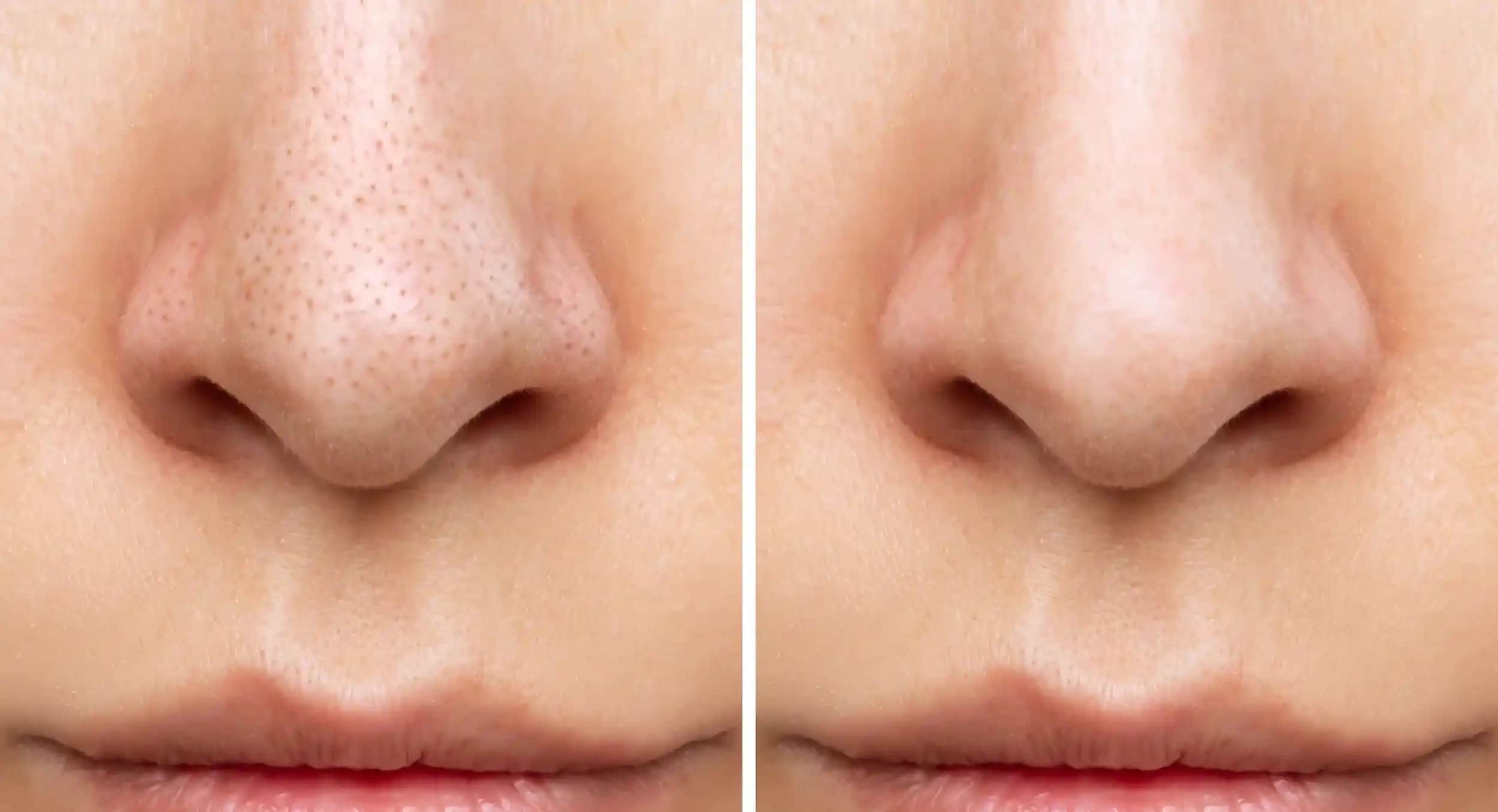 Yüzdeki Kapalı Komedonlar Nasıl Geçer: Etkili Tedavi ve Önleme Yöntemleri