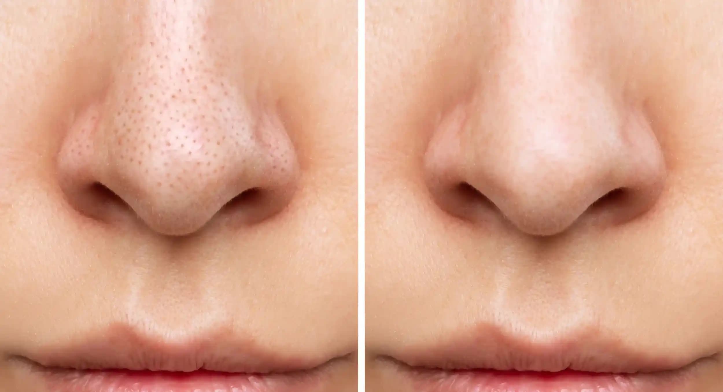 Yüzdeki Kapalı Komedonlar Nasıl Geçer: Etkili Tedavi ve Önleme Yöntemleri