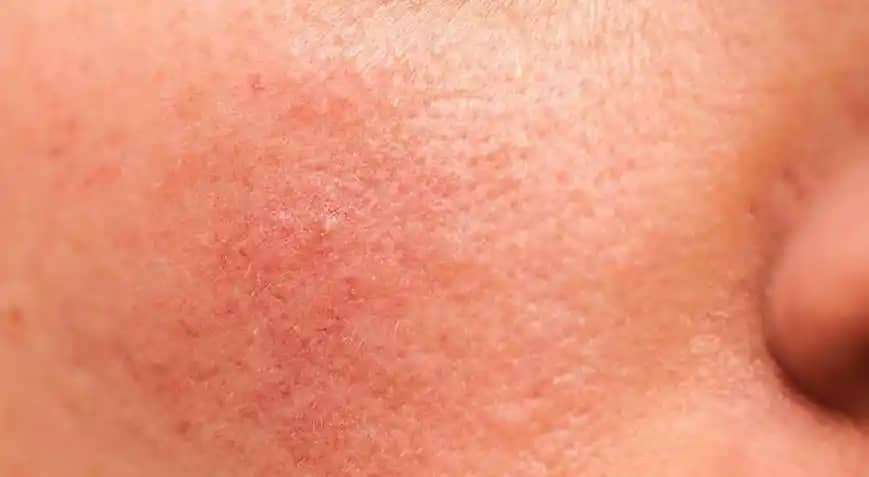 Yüzdeki Kaşıntı ve Kızarıklık Nasıl Geçer: Etkili Çözüm ve Bakım İpuçları