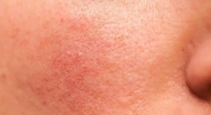 Yüzdeki Kaşıntı ve Kızarıklık Nasıl Geçer: Etkili Çözüm ve Bakım İpuçları