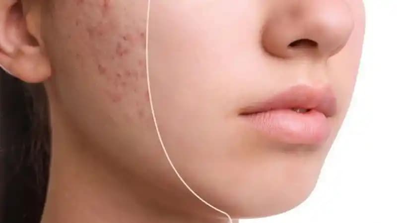 Yüzdeki Kızarıklık Ne Kadar Sürede Geçer ve Cilt Bakımında Dikkat Edilmesi Gerekenler