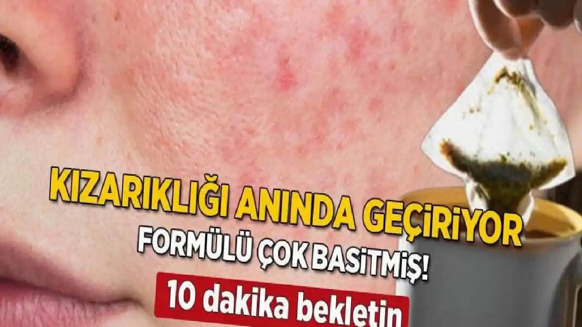 Yüzdeki Kızarıklıkların Nedenleri ve Etkili Bakım Yöntemleri