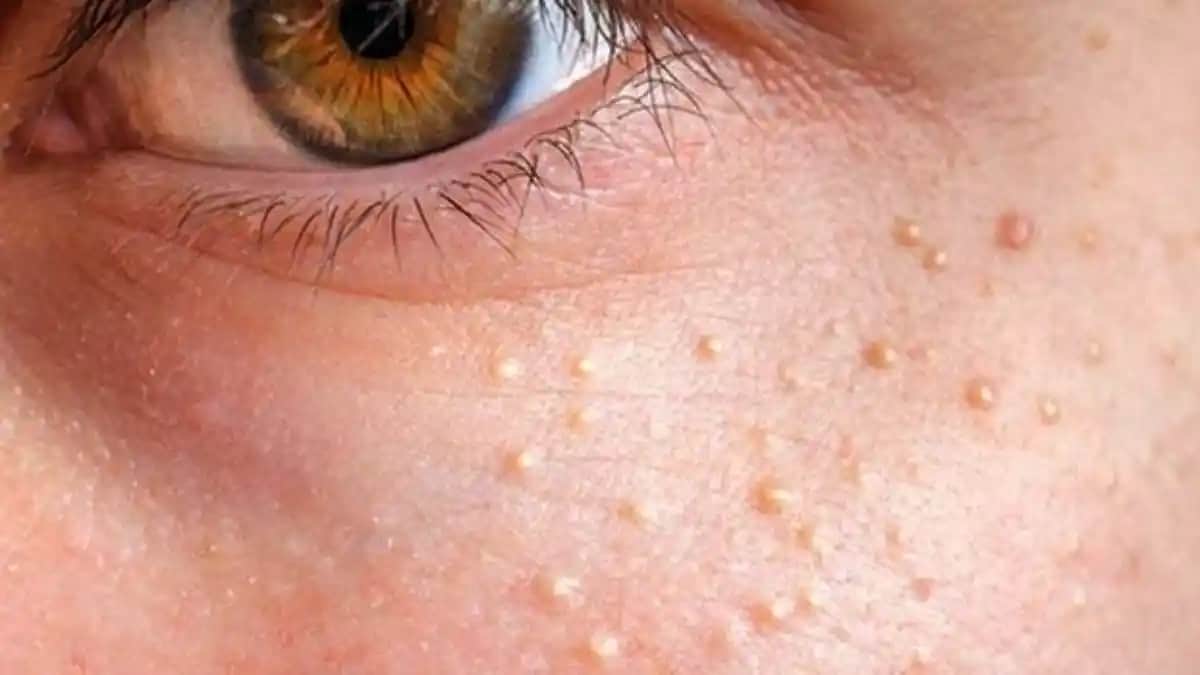 Yüzdeki Komedonlara Karşı Etkili Bakım Yöntemleri ve Doğal Çözümler