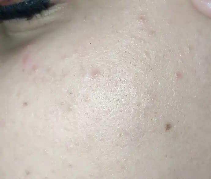 Yüzdeki Küçük Sivilcelerle Etkili Başa Çıkma Yöntemleri ve Cilt Sağlığı İpuçları