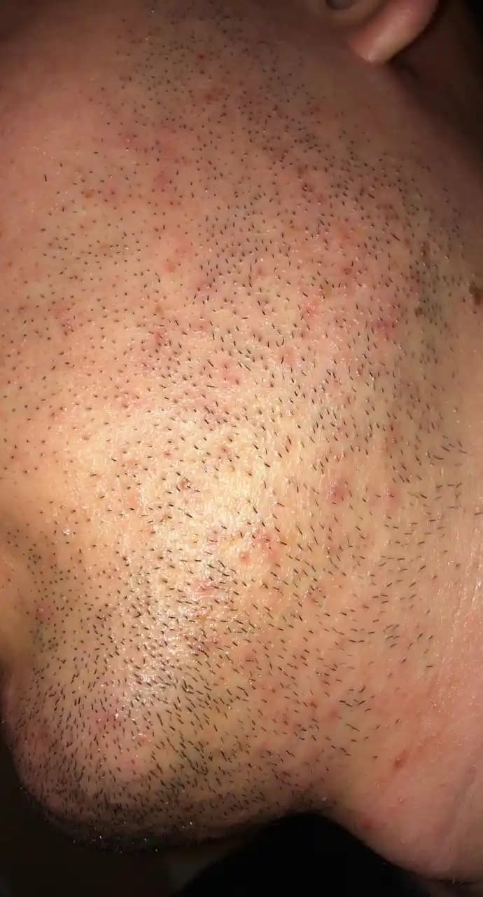 Yüzdeki Minik Sivilcelerin Nedenleri ve Etkili Bakım Yöntemleri Hakkında Bilgi