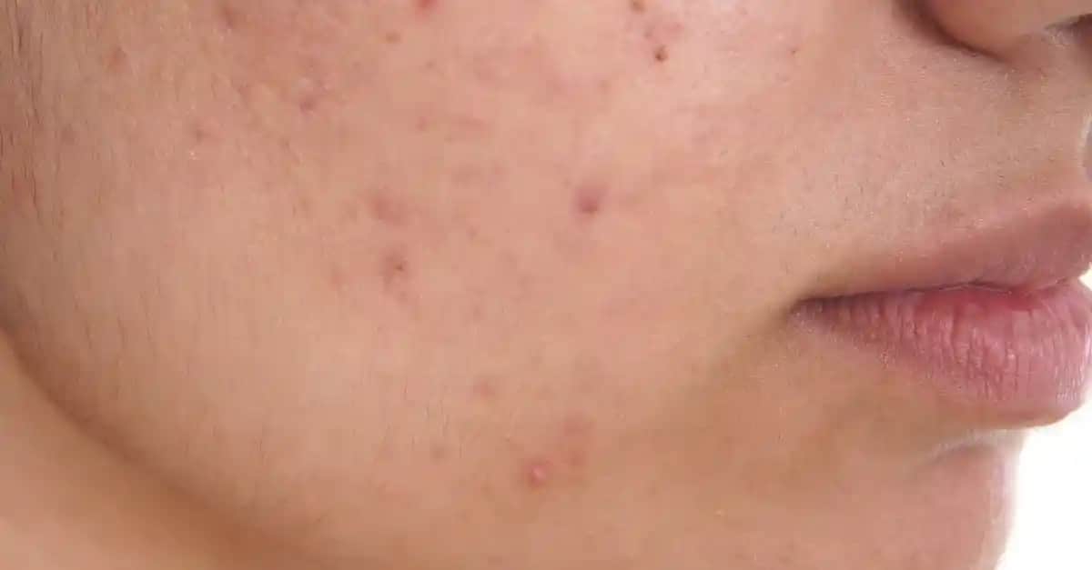 Yüzdeki Sivilce Lekeleriyle Mücadele Yöntemleri ve Cilt Sağlığı İpuçları