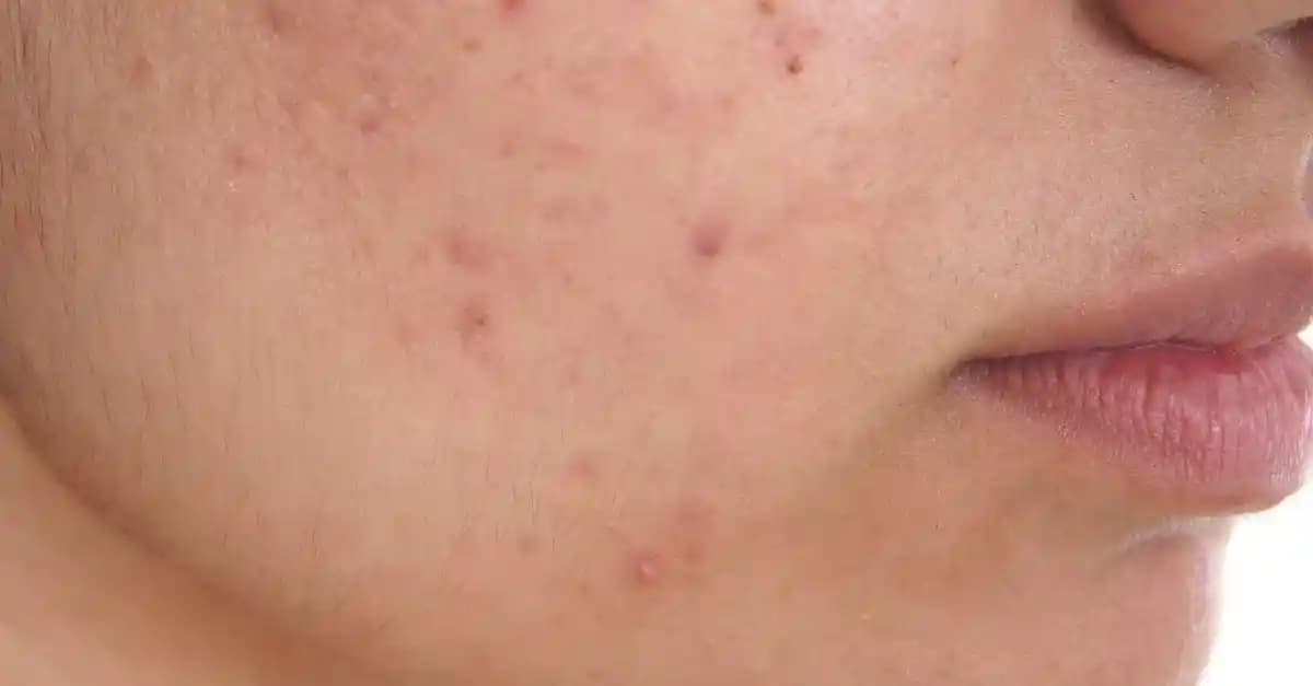 Yüzdeki Sivilce Lekeleriyle Mücadele Yöntemleri ve Cilt Sağlığı İpuçları