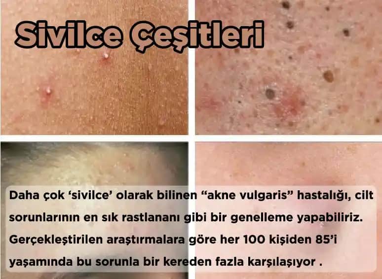 Yüzdeki Sivilce Türleri, Nedenleri ve Etkili Bakım Yöntemleri Hakkında Kapsamlı Bilgi