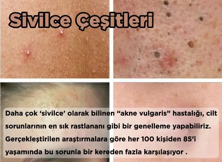 Yüzdeki Sivilce Türleri, Nedenleri ve Etkili Bakım Yöntemleri Hakkında Kapsamlı Bilgi