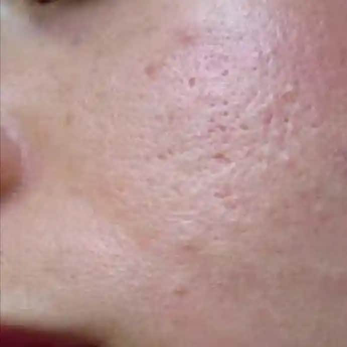 Yüzdeki Sivilcelerin Nedenleri ve Cilt Sağlığını Koruma Yöntemleri