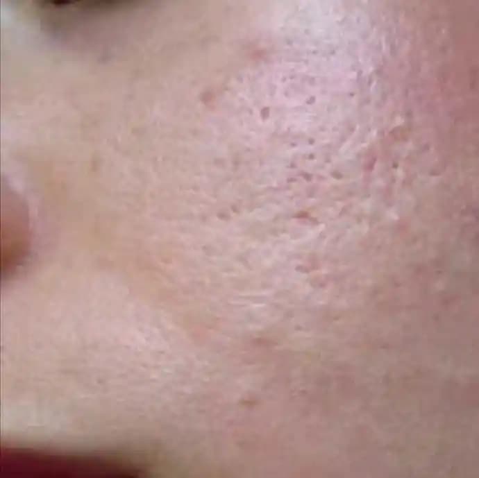 Yüzdeki Sivilcelerin Nedenleri ve Cilt Sağlığını Koruma Yöntemleri