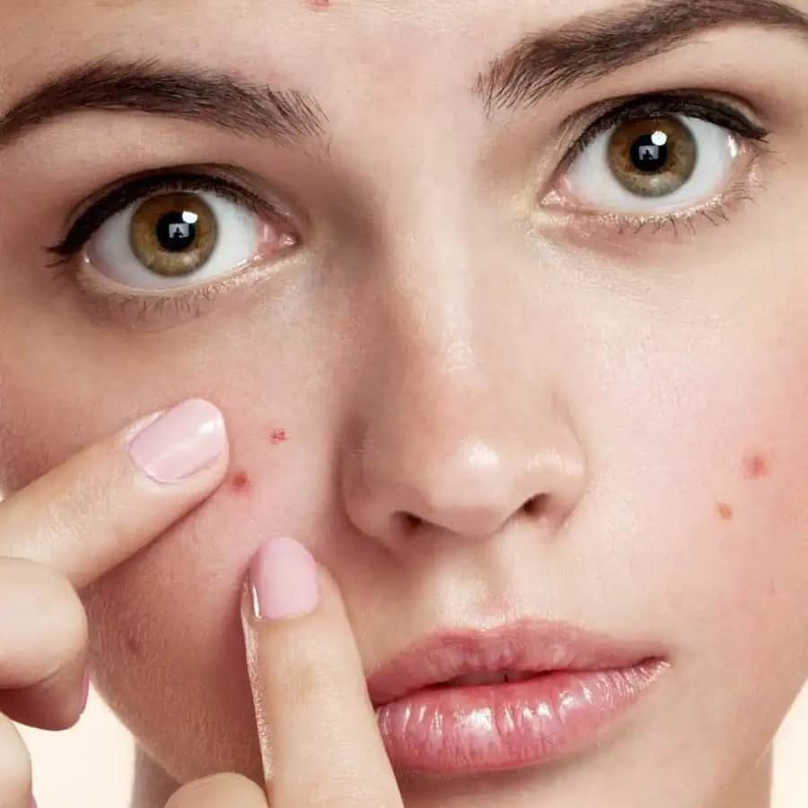 Yüzdeki Sivilcelerin Nedenleri ve Etkili Önleme Yöntemleri