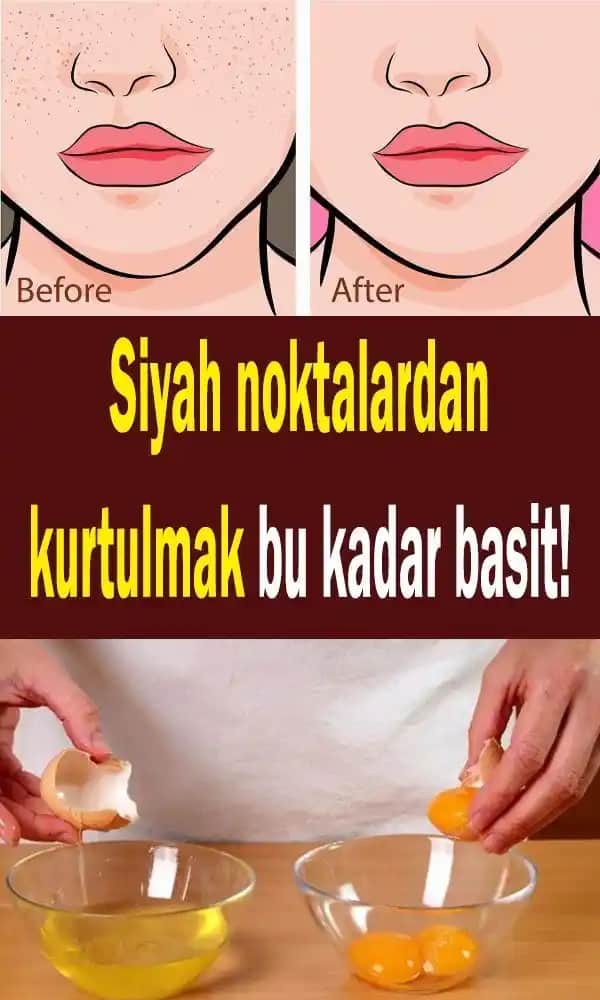 Yüzdeki Siyah Noktalar Nasıl Geçer: Doğal ve Etkili Evde Çözüm Yöntemleri