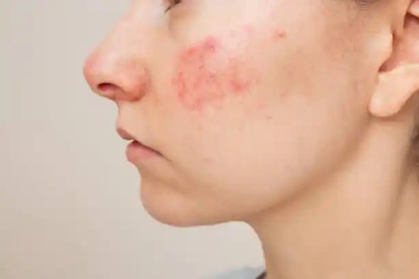 Yüzdeki Tahrişi Hafifletmek ve Cilt Sağlığını Koruma Yöntemleri