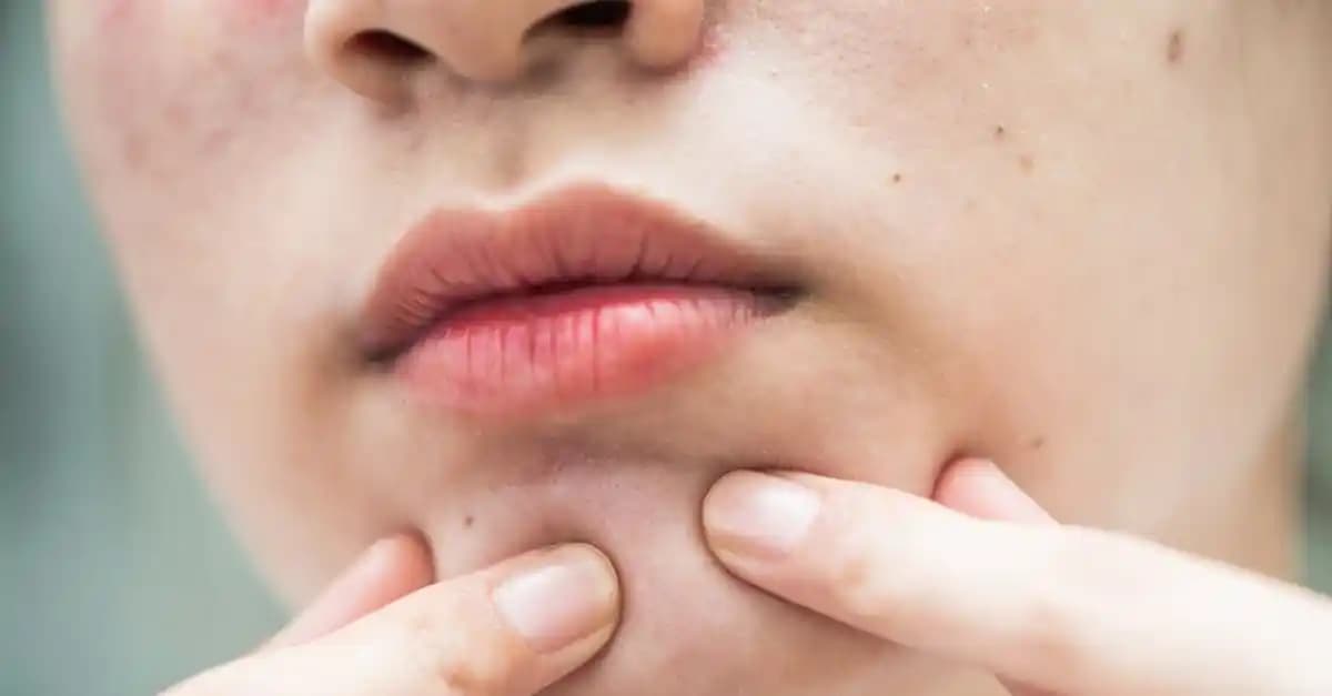 Yüzdeki Tırnak Yaralarına Karşı Etkili Doğal ve Tıbbi Çözüm Yöntemleri