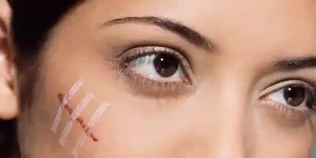 Yüzdeki Yara İzlerini Azaltmak İçin Doğal Yöntemler ve Bakım İpuçları