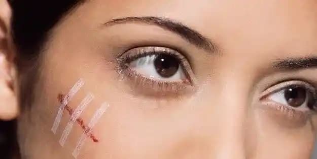 Yüzdeki Yara İzlerini Azaltmak İçin Doğal Yöntemler ve Bakım İpuçları