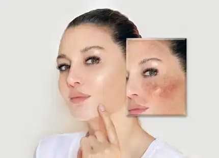 Yüzdeki Yara ve Lekeleri Yok Etme Yöntemleri: Doğal ve Profesyonel Çözümler