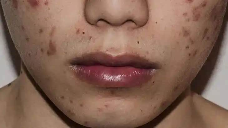 Yüzdeki Yaraların İyileşme Süresi ve Hızlandırıcı Yöntemler