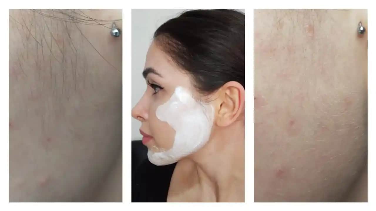 Yüze Tüy Sarartıcı Uygulaması: Güvenli ve Etkili Cilt Bakımı Rehberi