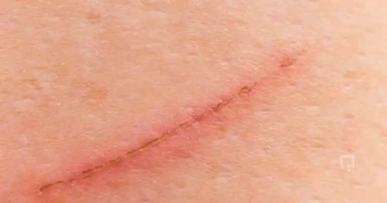 Yüzeysel Tırnak İzi Nedir, Nedenleri ve Sağlıklı Bakım Yöntemleri