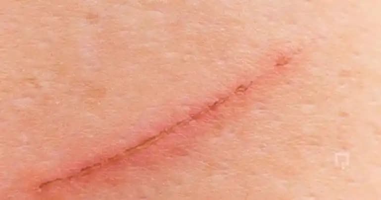 Yüzeysel Tırnak İzi Nedir, Nedenleri ve Sağlıklı Bakım Yöntemleri