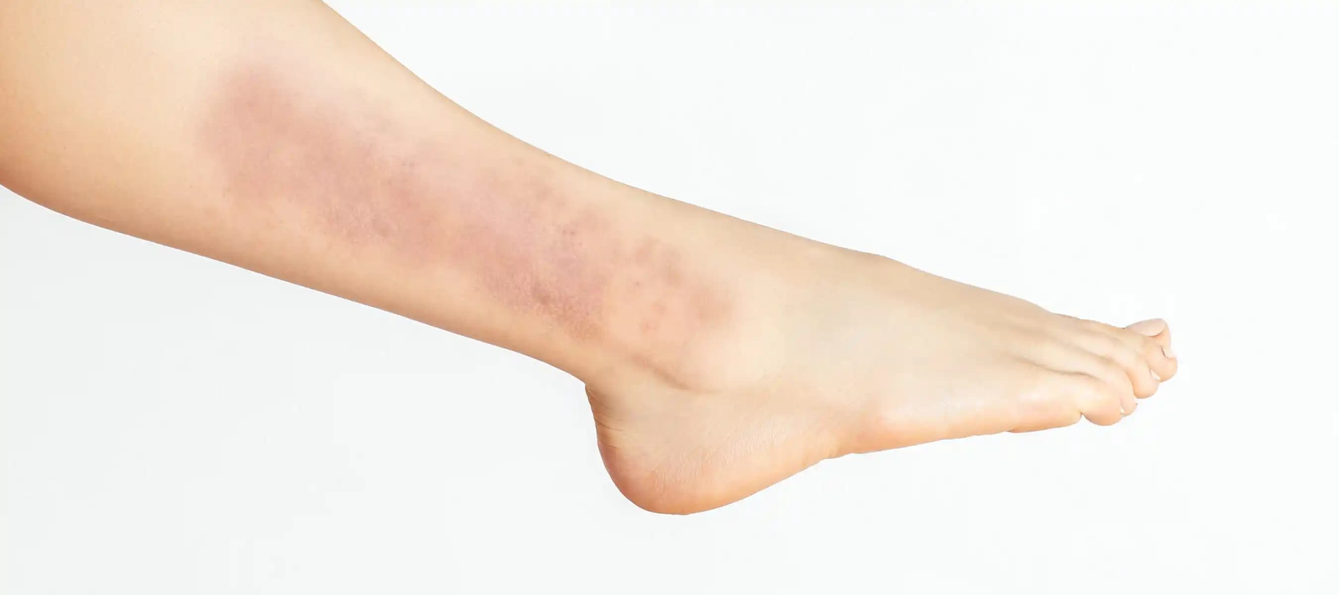 Bacak Egzaması: Nedenleri, Belirtileri ve Etkili Tedavi Yöntemleri Hakkında Bilgi