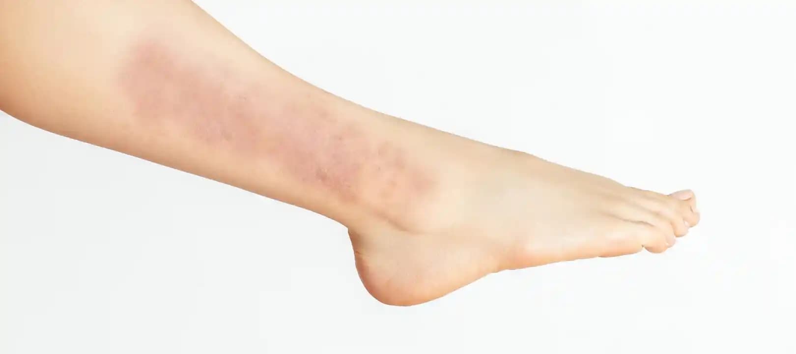 Bacakta Egzama: Belirtiler, Tedavi Yöntemleri ve Cilt Bakımı Yaklaşımları