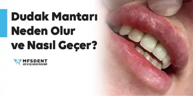 Dudakta Beyaz Mantar: Belirtileri, Nedenleri ve Etkili Bakım Yöntemleri