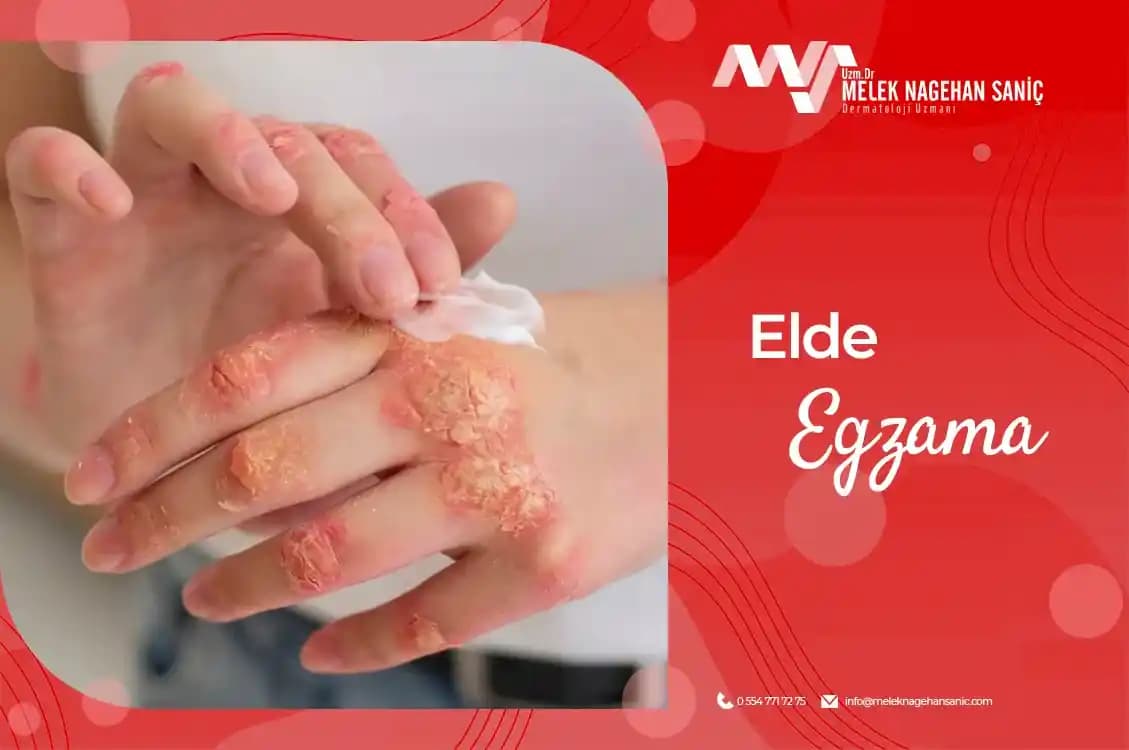 Elde Sulu Egzama: Belirtileri, Tedavi Yöntemleri ve Etkili Cilt Bakımı