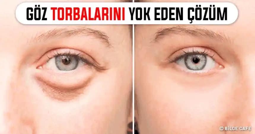 Göz Altı Şişkinliği Nedenleri ve Çözüm Yolları: Güncel Bilgi ve Değerlendirme